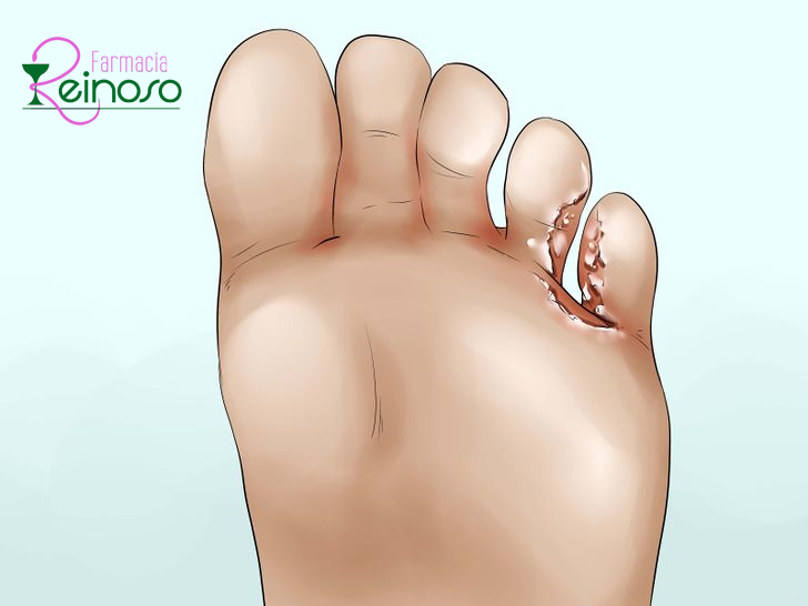¿Qué es el pie de atleta?